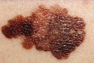 melanoma